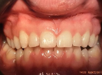 Braces after 3031447