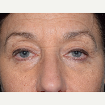 55-64 year old woman treated with Eyelid Surgery after 3093058