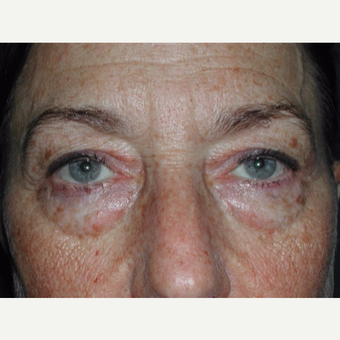 55-64 year old woman treated with Eyelid Surgery before 3093058