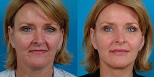 48-year-old woman treated with Facial Fat Transfer. before 3282151