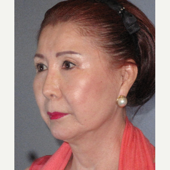 65-74 year old woman treated with Neck Lift before 3650790