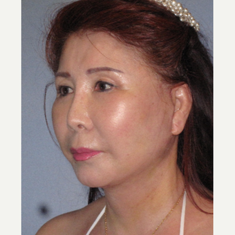 65-74 year old woman treated with Neck Lift after 3650790