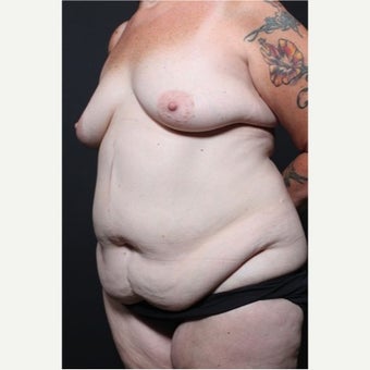 45-54 year old woman treated with Body Lift 1596985