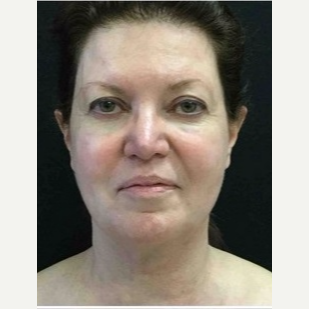 55-64 year old woman treated with Ultherapy after 3179965