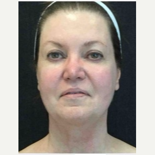 55-64 year old woman treated with Ultherapy before 3179965