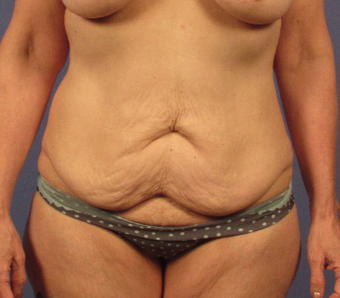 45-54 year old woman treated with Tummy Tuck before 3768932