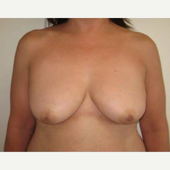 45-54 year old woman treated with Breast Lift with Implants before 3726257