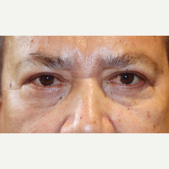 55-64 year old man treated with Blepharoplasty Surgery after 3589260