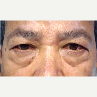 55-64 year old man treated with Blepharoplasty Surgery before 3589260