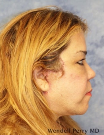 45-54 year old woman treated with Facelift after 3359445