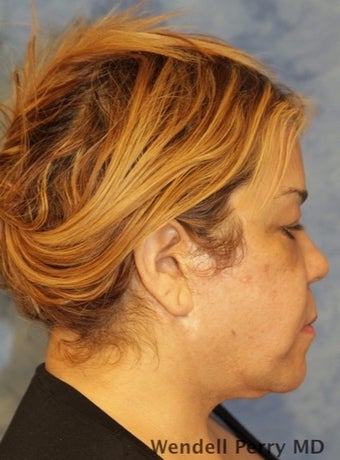 45-54 year old woman treated with Facelift before 3359445