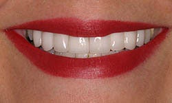 Dark, crooked bridge and crowns treated with new porcelain bridge, crowns and veneers. after 1326619