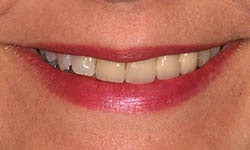 Dark, crooked bridge and crowns treated with new porcelain bridge, crowns and veneers. before 1326619
