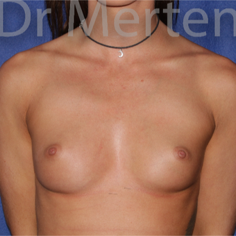 18-24 year old woman treated with Breast Augmentation before 3551985
