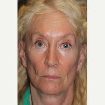 65-74 year old woman treated with Eyelid Surgery after 3286723