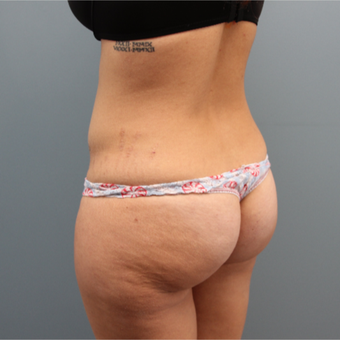 33 year old woman had a Brazilian Butt Lift before 3467352