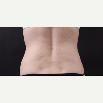 49 year old woman treated with CoolSculpting after 3630248