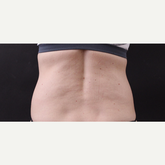 49 year old woman treated with CoolSculpting before 3630248