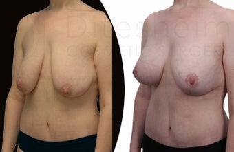 30 year old woman after 100 pound weight loss before 1127649