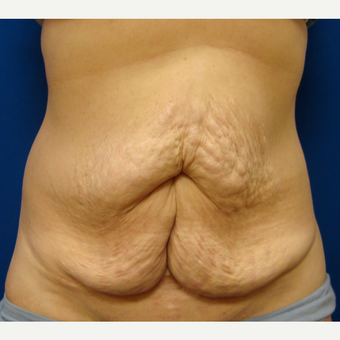 45-54 year old woman treated with Tummy Tuck before 3669502