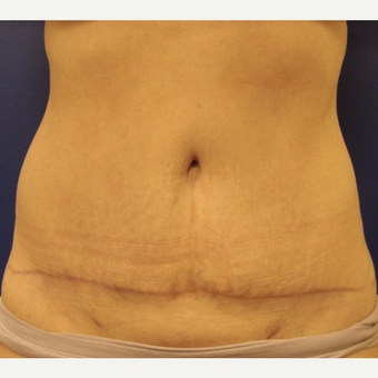 45-54 year old woman treated with Tummy Tuck after 3669502
