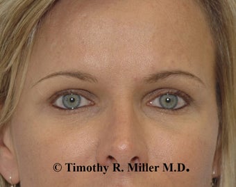 Fat augmentation for facial rejuvenation after 1448272