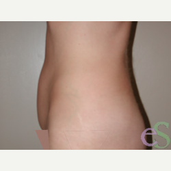 41 year old woman treated with Tummy Tuck before 3484826