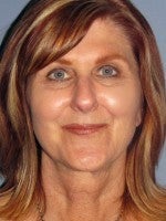 55-64 year old woman treated with Neck Lift before 3103954