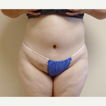 45-54 year old woman treated with Tummy Tuck after 3191770