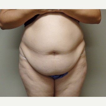 45-54 year old woman treated with Tummy Tuck before 3191770