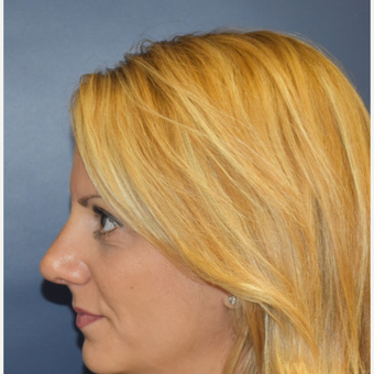 35-44 year old woman treated with Rhinoplasty after 3131240