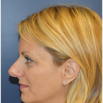 35-44 year old woman treated with Rhinoplasty before 3131240