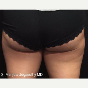 Minimizing Fat on Upper Posterior Thighs with Kybella Injections before 3535176