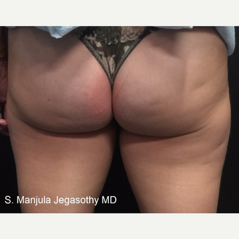Minimizing Fat on Upper Posterior Thighs with Kybella Injections after 3535176