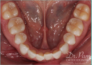 35-44 year old woman treated with Lingual Braces before 3498175