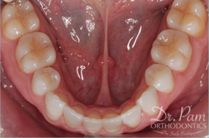 35-44 year old woman treated with Lingual Braces after 3498175