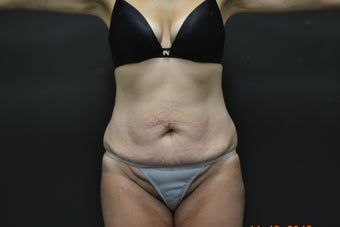 45-54 year old woman treated with Tummy Tuck before 2547661