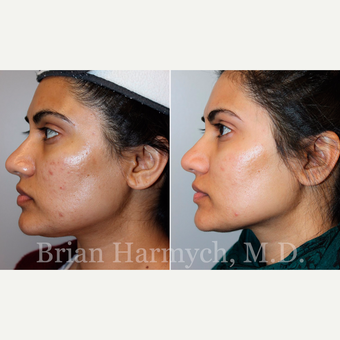 34 year-old female before and after Acne Treatment with Microneedling (series of 3 treatments) before 3446217
