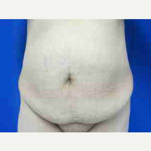 Body Lift before 3100160