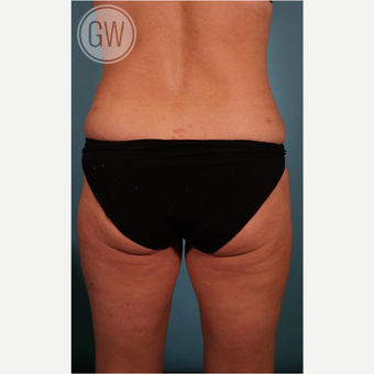 35-44 year old woman treated with Liposculpture after 3016664
