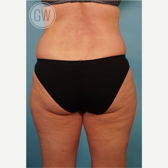 35-44 year old woman treated with Liposculpture before 3016664