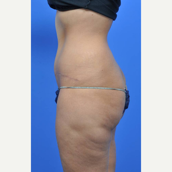 25-34 year old woman treated with Tummy Tuck after 3449715