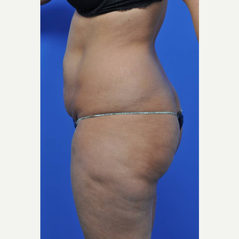 25-34 year old woman treated with Tummy Tuck before 3449715