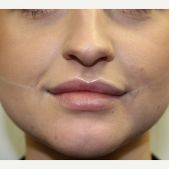 Facial slimming with BOTOX before 3670857