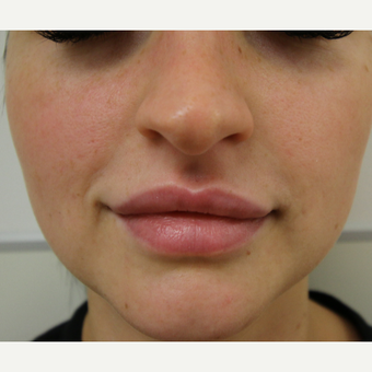 Facial slimming with BOTOX after 3670857