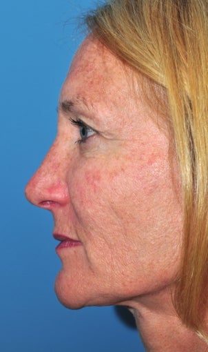 female-treated-for-sun-damaged-skin-photo-from-ryan-greene-md-phd