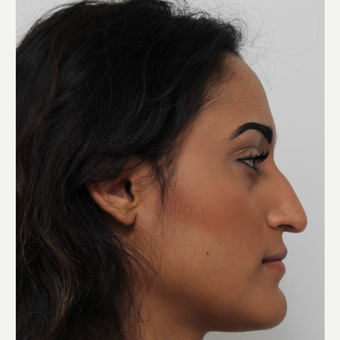 25-34 year old woman treated with Rhinoplasty before 3372289