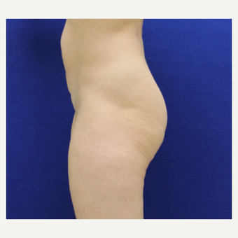 35-44 year old woman treated with Brazilian Butt Lift before 3482350