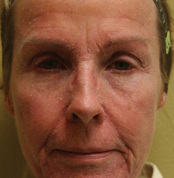 Croton Oil Peel Results After 3 Months before 1203400