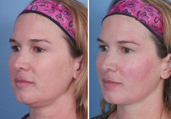Thermage before and immidately after before 1105943